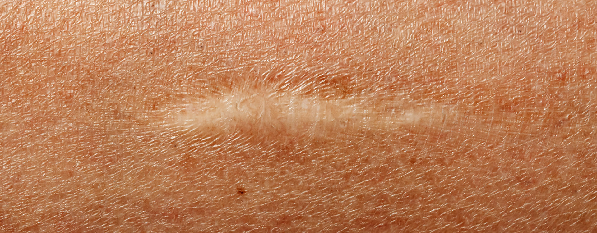 Dr Diego Loureiro - Cirurgias Reconstrutoras - Cicatrizes