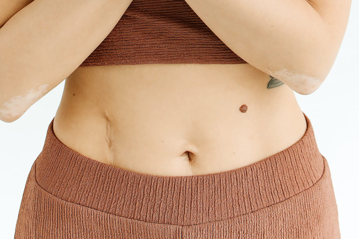 Dr Diego Loureiro - Cirurgias Reconstrutoras - Cicatrizes