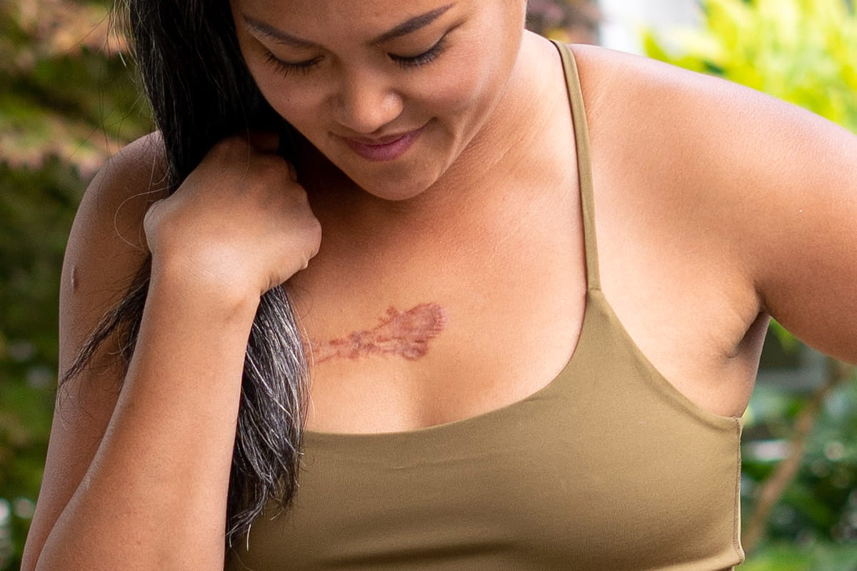 Dr Diego Loureiro - Cirurgias Reconstrutoras - Queloide