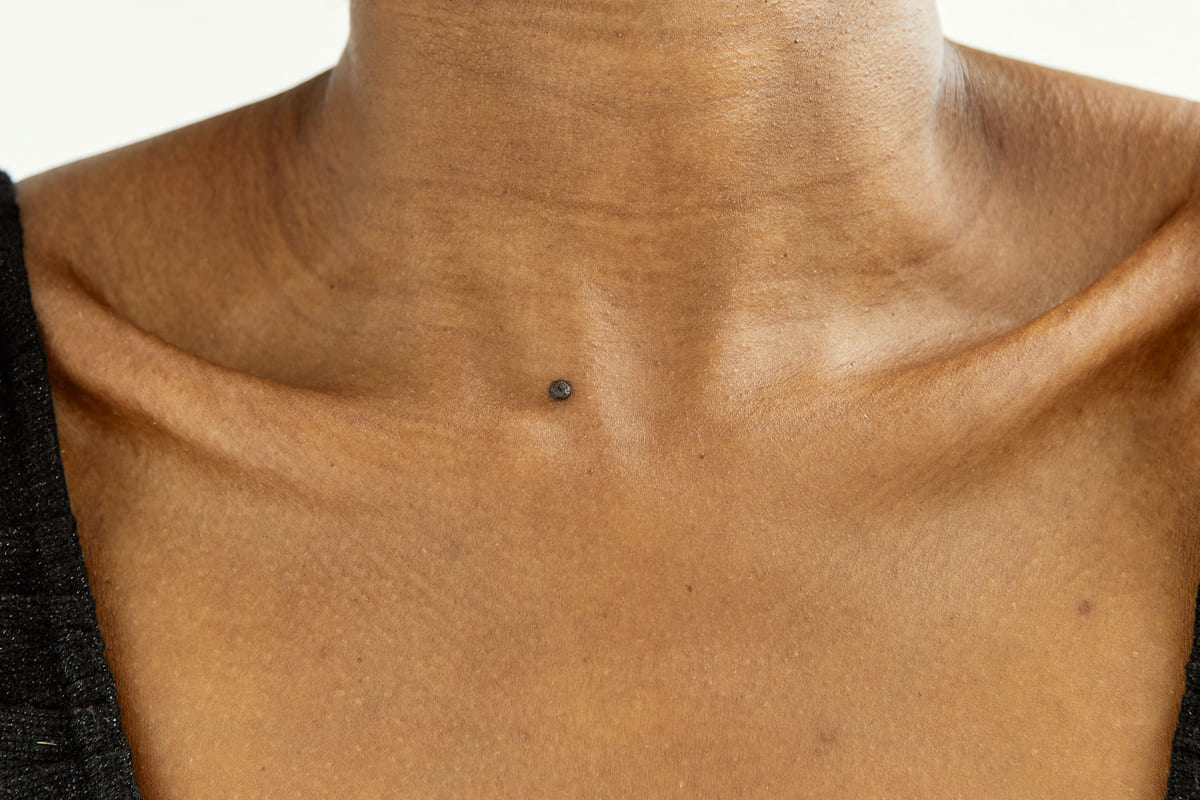 Dr Diego Loureiro - Cirurgias Reconstrutoras - Tumores Cutâneos