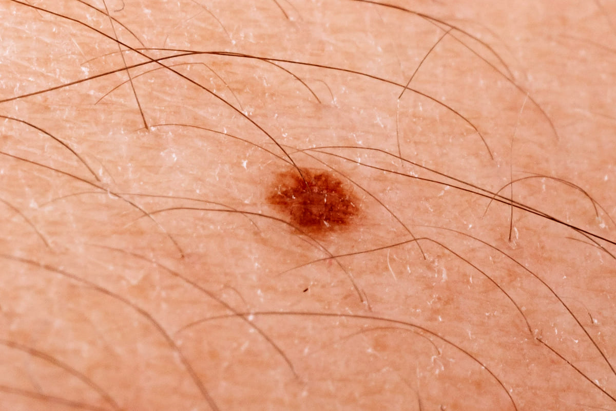 Dr Diego Loureiro - Cirurgias Reconstrutoras - Tumores Cutâneos