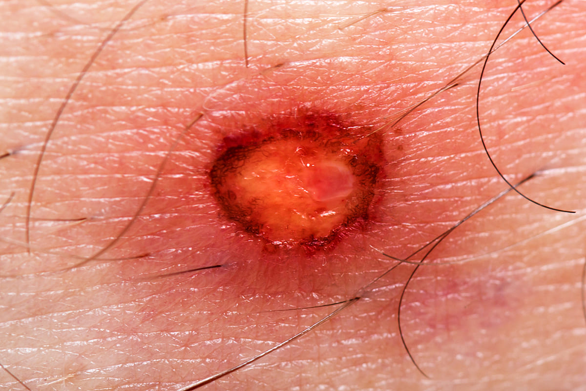 Dr Diego Loureiro - Cirurgias Reconstrutoras - Tumores Cutâneos