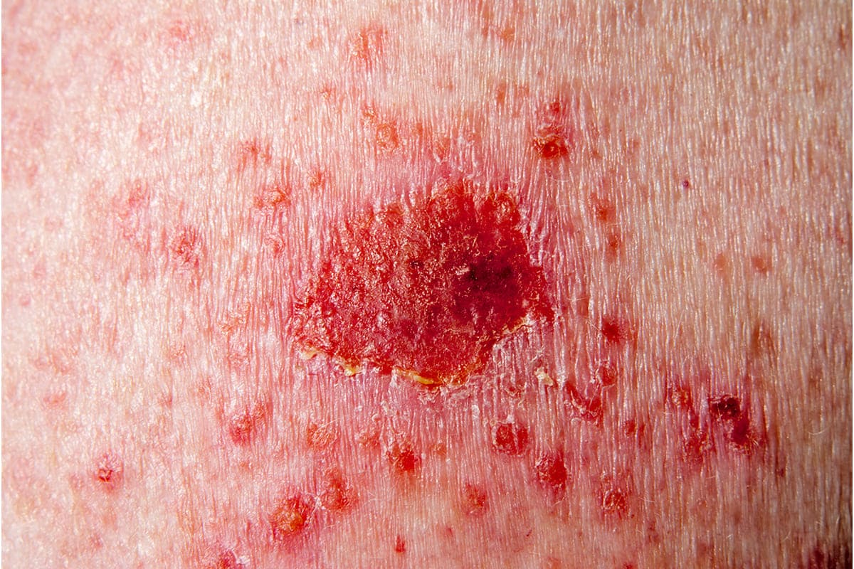 Dr Diego Loureiro - Cirurgias Reconstrutoras - Tumores Cutâneos