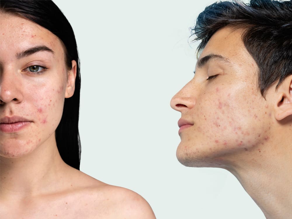 Dr Diego Loureiro - Cicatrizes de Acne