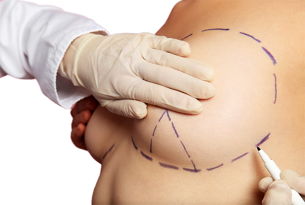 Cirurgias para aumentar as mamas