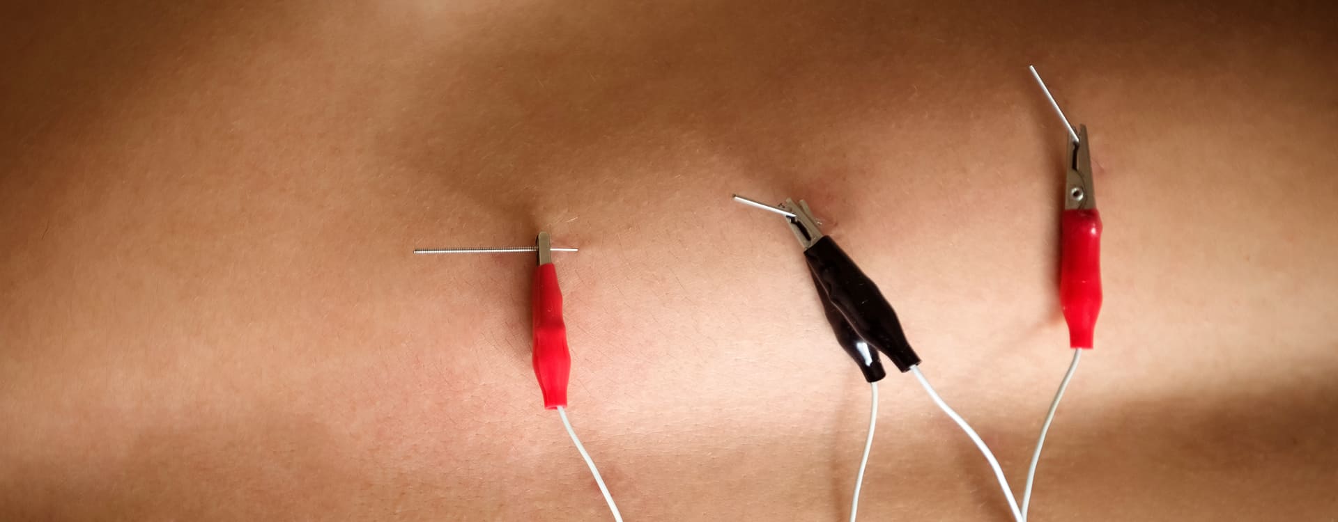 Dr Diego Loureiro - Tratamentos Corporais - Eletrolipólise